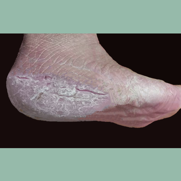 脚跟开裂、足跟疼、脚掌疼是什么原因