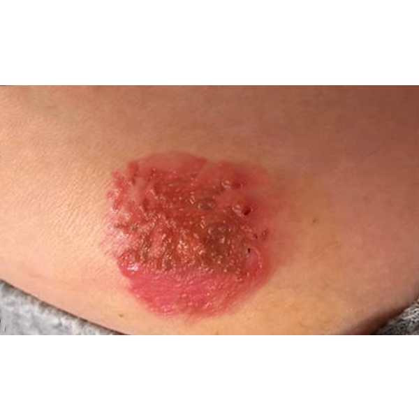 脸上长痘痘、身上某部位冒出脓疱、糜烂…，冬季皮肤问题要注意