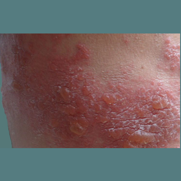 冬季容易纠缠人的皮肤问题有哪些