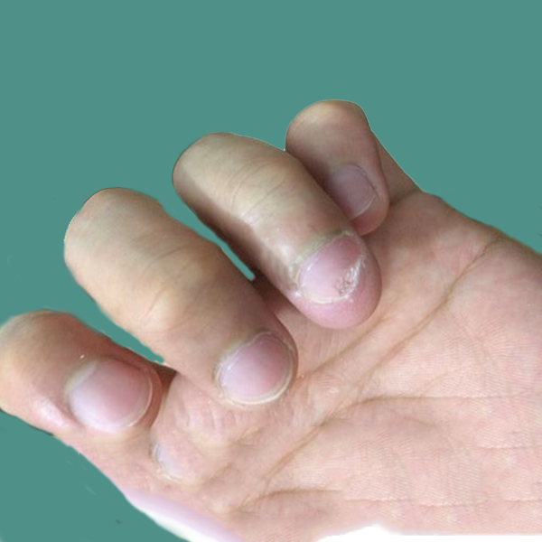 春天万物生长，灰指甲真菌“蠢蠢欲动”，指甲这些表现要警惕