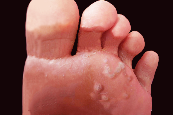 手、脚上开始长刺瘊，皮肤会有哪些变化和提示？