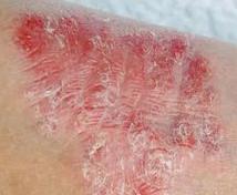 皮肤上发红、起水疱、丘疹，发痒， 不一定过敏