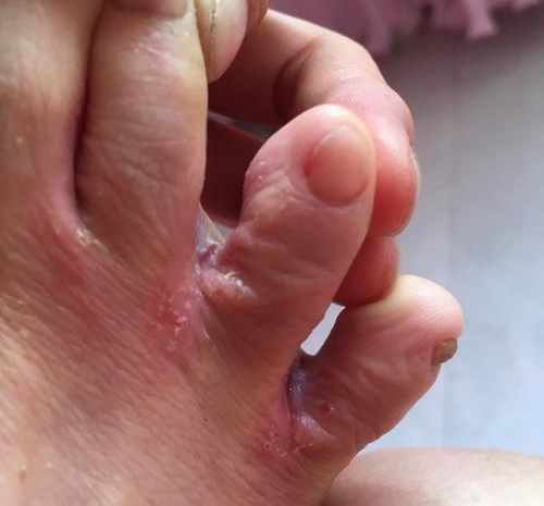 脚上起水疱、瘙痒、糜烂，未必是脚气，也可是湿疹！