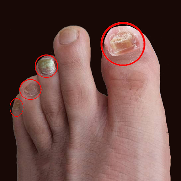 灰指甲反复长，试过多个方法也长不好，原因卡在哪里？